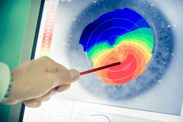 doctor pointing at a corneal scan