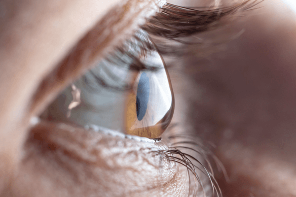 close up of eye with a cone-shaped cornea