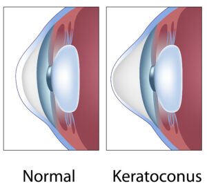 image of cornea with keratoconus with cornea bulging