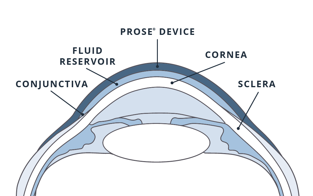 PROSE-Diagram_1_Fill